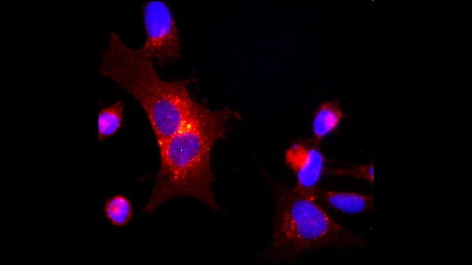 A photomicrograph of abnormal cells displays bright pinks and purples