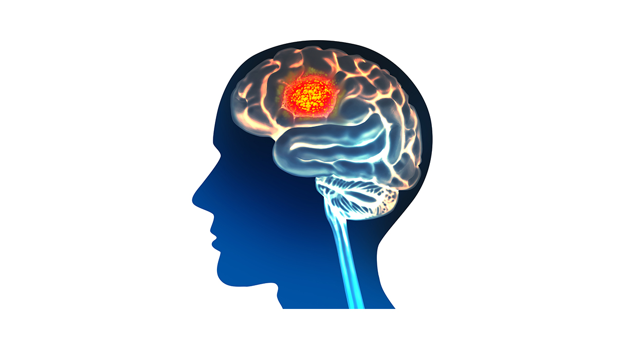 An illustration of a head and brain with brain tumor highlighted in bright red