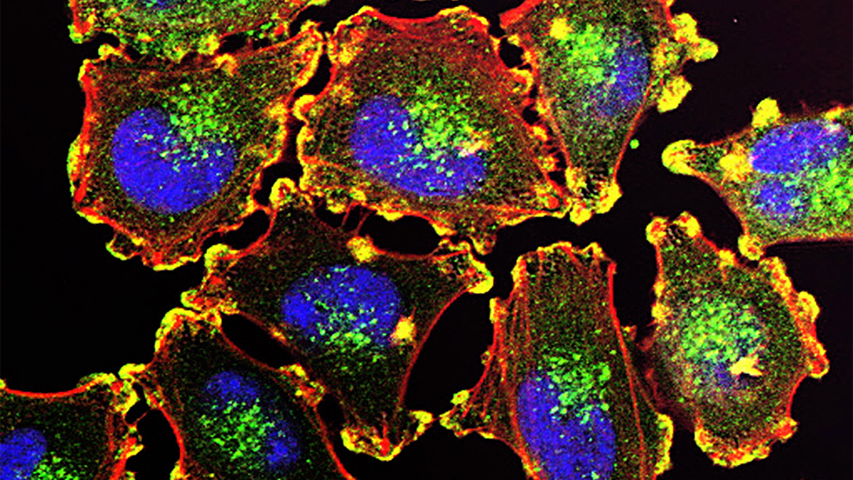 A microscopic view of melanoma cells with cell structures depicted in bright colors