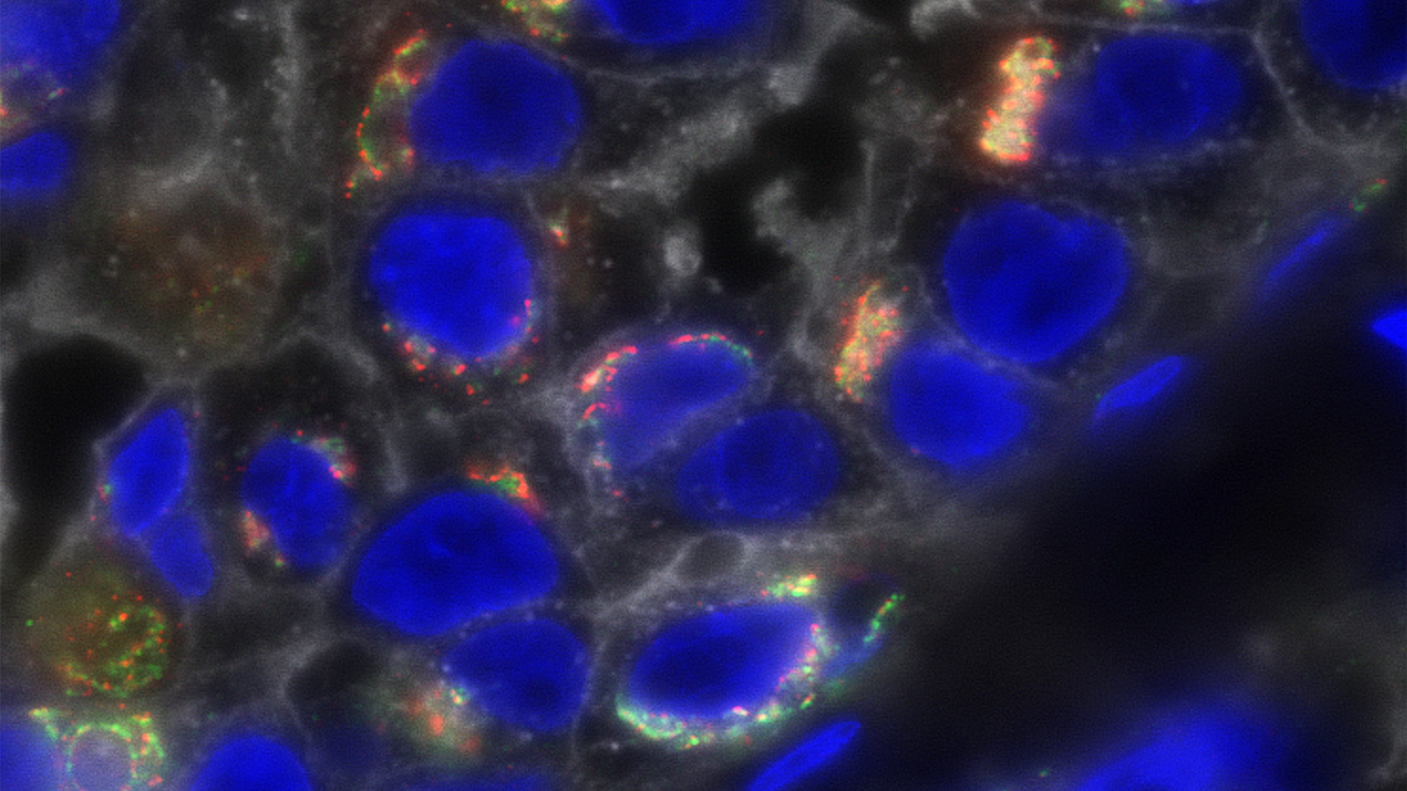 Clinical triple-negative breast cancer is stained for bone morphogenetic protein-11 (red); the Golgi marker GM130 (green); glycosylated proteins (white); and nuclei (blue)