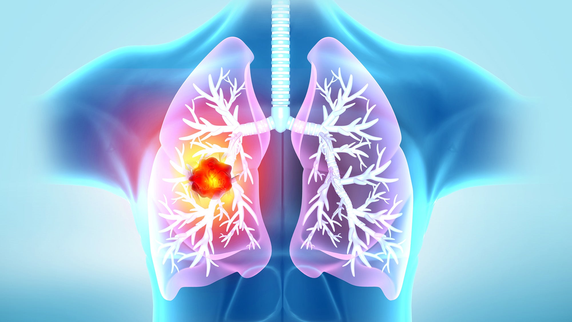 Illustration of lungs inside a chest displaying a large red spot indicating cancer