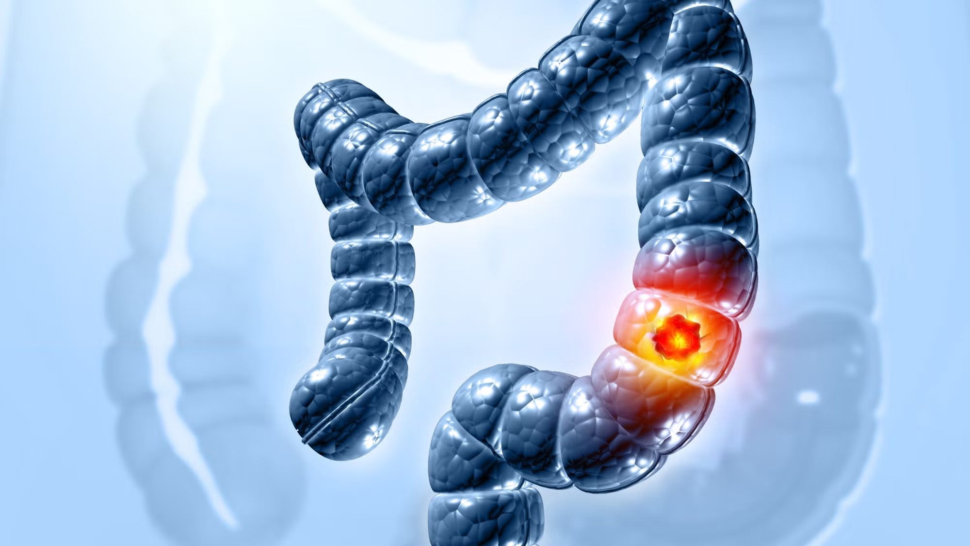 Illustration of a large intestine with segment highlighted to indicate cancer